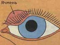 Как вылечить ячмень на глазу Ячмень на глазу