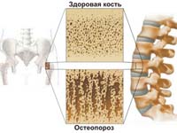 Остеопороз Остеопороз