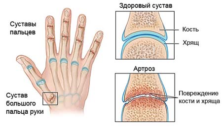 Артроз пальцев руки схема артроз пальцев руки