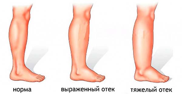 Как избавиться от отечности и тяжести в ногах отечность ног схема фото