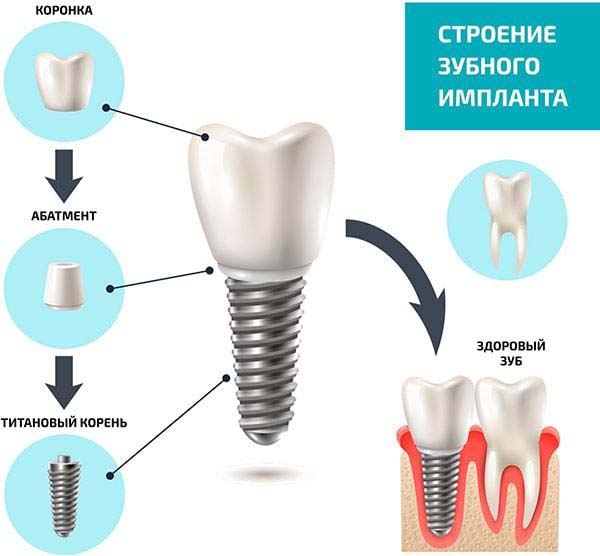 Что такое зубной имплант