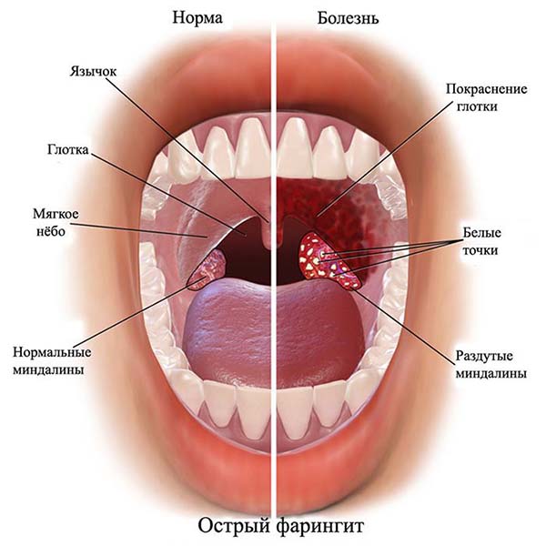 Причина постоянно красного горла красное горло схема фото
